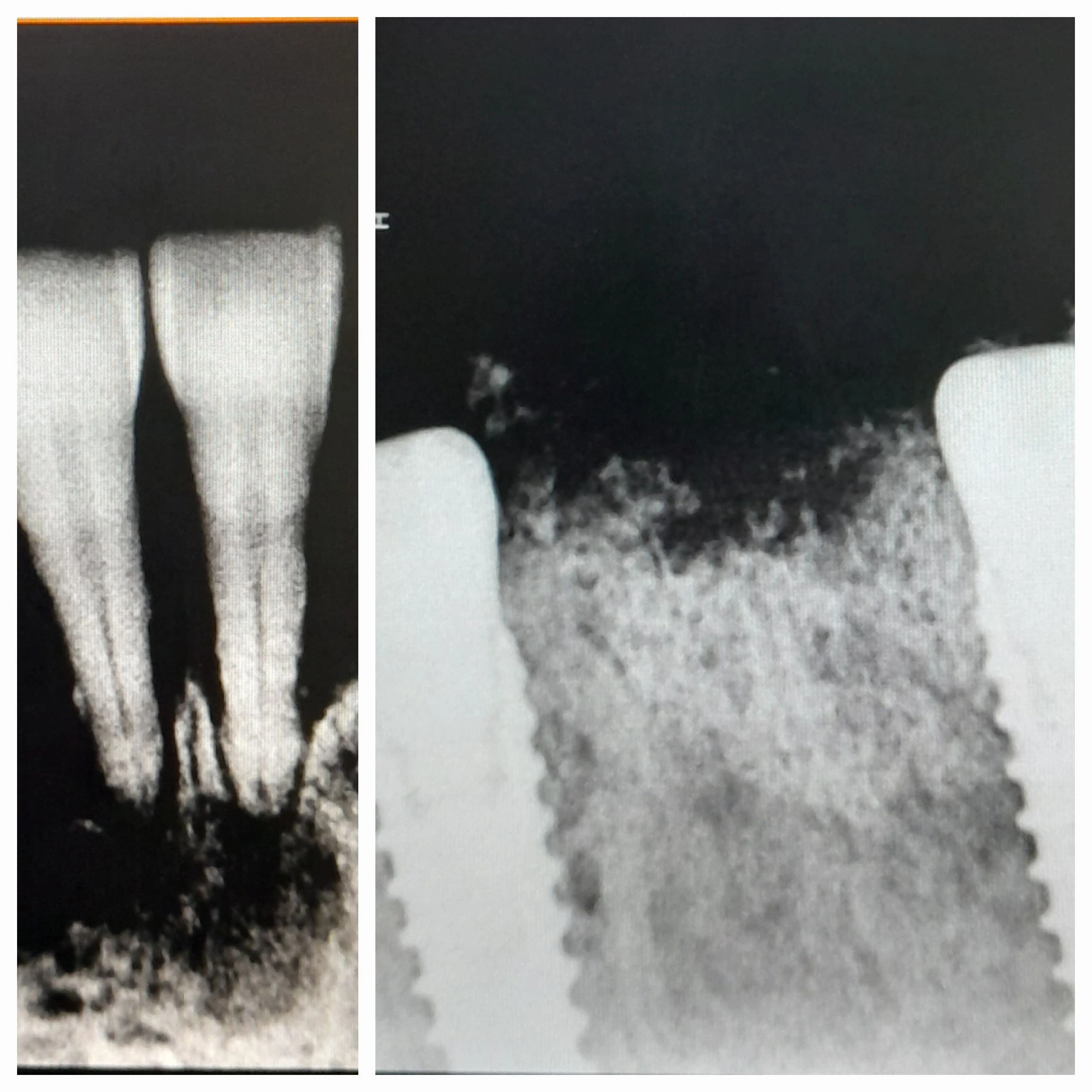 Implant done at Sterling Dental Clinic